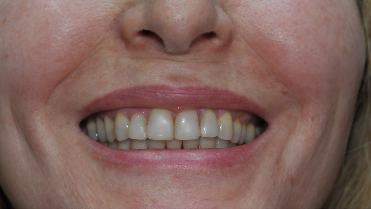 Before and after smiles at Alleman Family Dental Boulder, CO